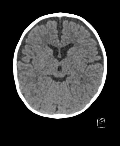 File:Benign enlargement of subarachnoid spaces in infancy (BESS) (Radiopaedia 87459-103795 Axial non-contrast 49).jpg