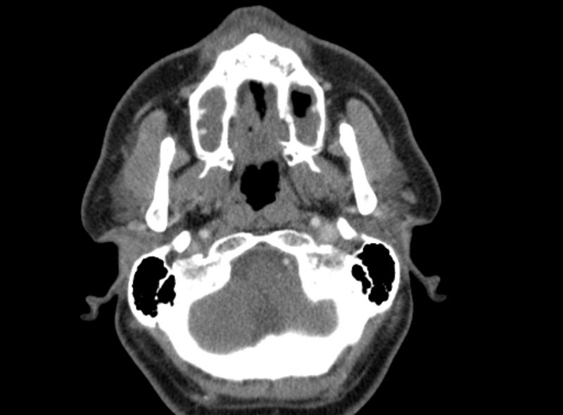 File:Benign mixed salivary tumor of the parotid gland (Radiopaedia 35261-36792 A 13).jpg