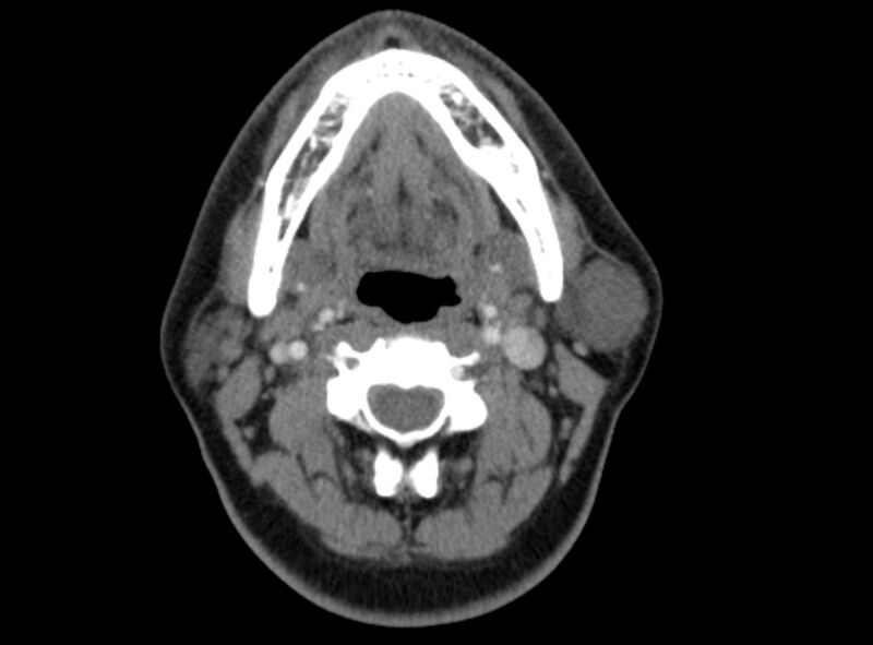 File:Benign mixed salivary tumor of the parotid gland (Radiopaedia 35261-36792 A 24).jpg