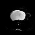 Benign seromucinous cystadenoma of the ovary (Radiopaedia 71065-81300 T2 SPAIR 19).jpg