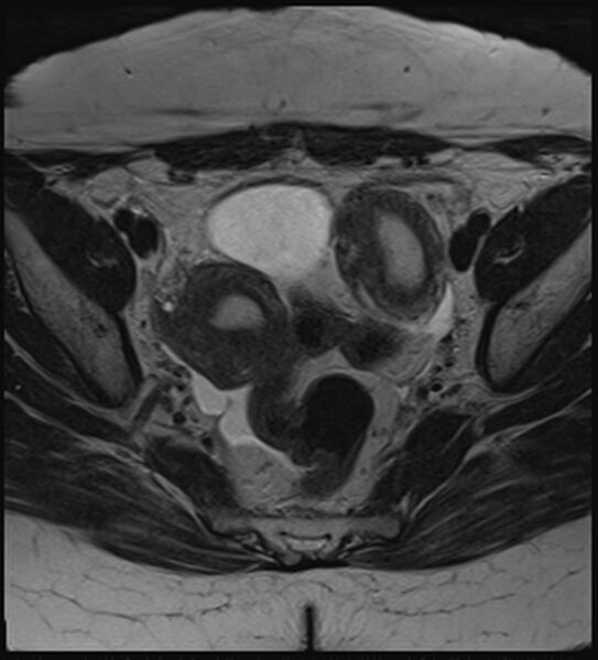 File:Bicornuate, unicollis uterus (Radiopaedia 79468-92593 Axial T2 9).jpg