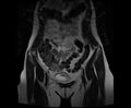 Bicornuate bicollis uterus (Radiopaedia 61626-69616 Coronal T2 6).jpg