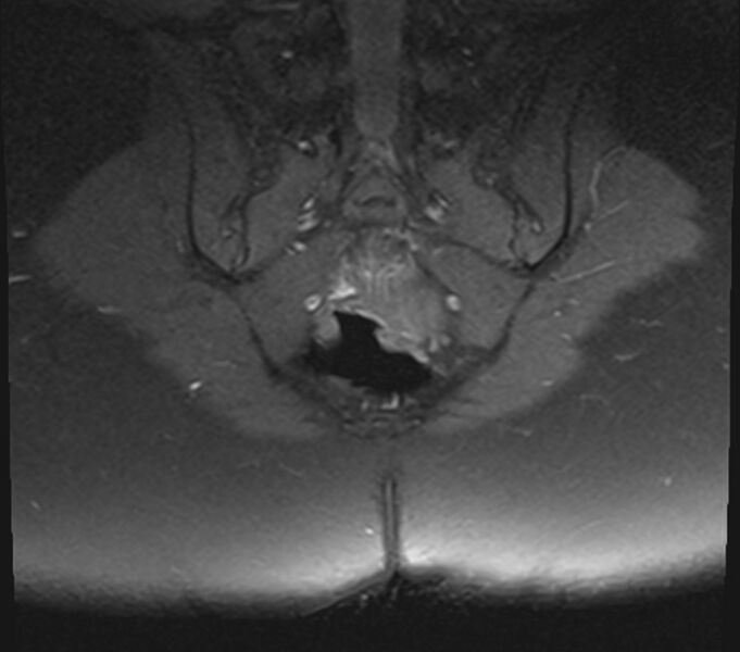 File:Bicornuate uterus (Radiopaedia 71214-81511 Coronal T1 fat sat 2).jpg