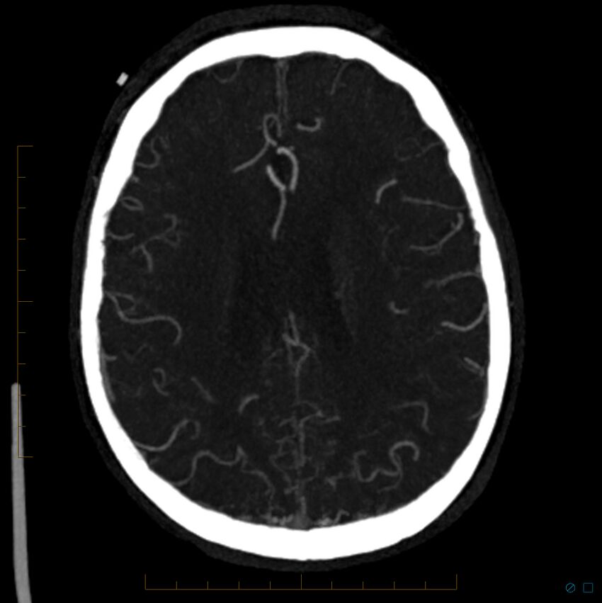 Bilateral chronic common carotid occlusion (Radiopaedia 50849-56362 D 11).jpg