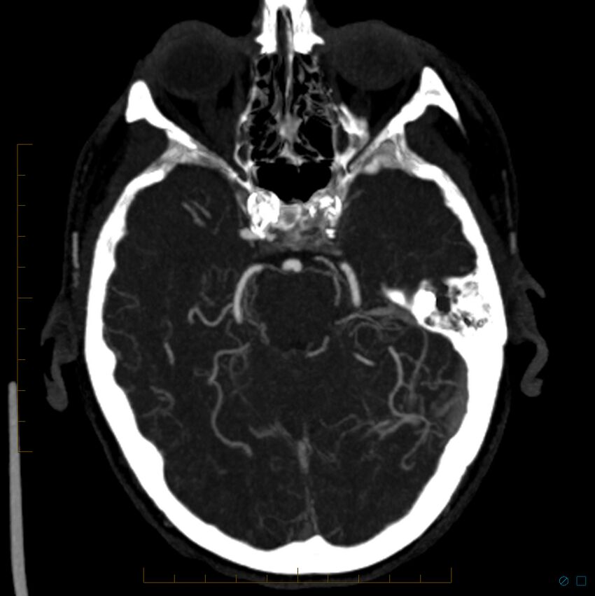 Bilateral chronic common carotid occlusion (Radiopaedia 50849-56362 D 20).jpg