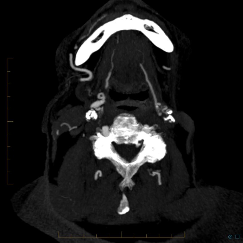 Bilateral chronic common carotid occlusion (Radiopaedia 50849-56362 D 39).jpg