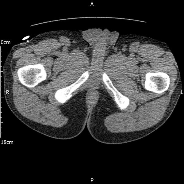 File:Bilateral medullary nephrocalcinosis with ureteric calculi (Radiopaedia 71269-81569 Axial non-contrast 146).jpg