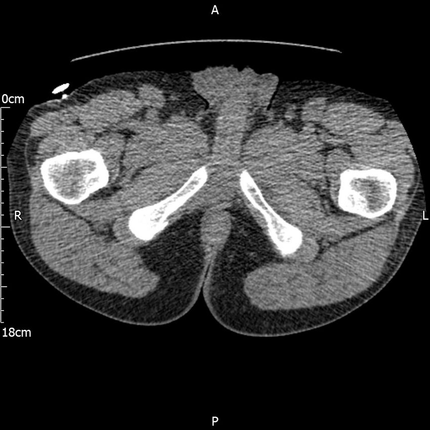 Bilateral medullary nephrocalcinosis with ureteric calculi (Radiopaedia 71269-81569 Axial non-contrast 146).jpg