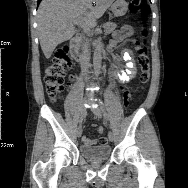 File:Bilateral medullary nephrocalcinosis with ureteric calculi (Radiopaedia 71269-81569 Coronal non-contrast 34).jpg