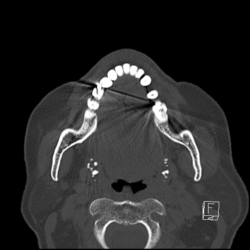 Bilateral palatine tonsilloliths on OPG and CT (Radiopaedia 75167-86247 Axial bone window 43).jpg