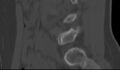 Bilateral pars defect (Radiopaedia 26691-26846 Sagittal bone window 44).jpg