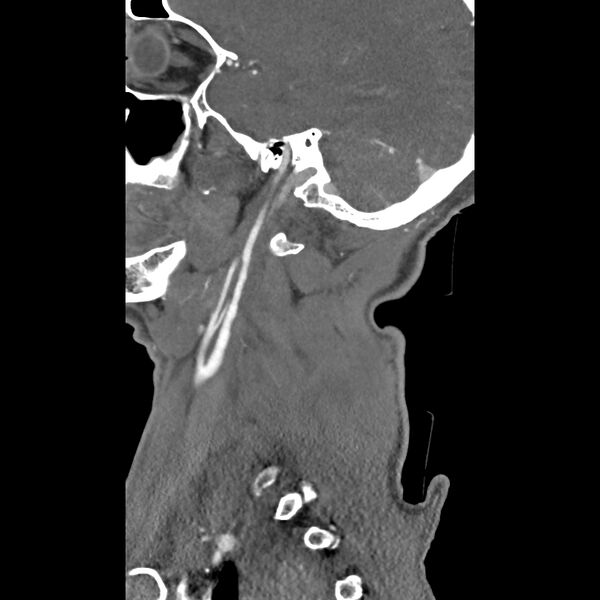 File:Bilateral perched facets with cord injury (Radiopaedia 45587-49713 B 7).jpg