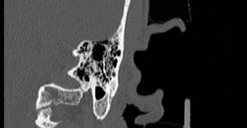 File:Bilateral temporal bone fractures (Radiopaedia 29482-29970 B 76).jpg