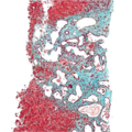 Biliary hamartoma (histology) (Radiopaedia 9637-10271 Low-power Trichrome 1).png