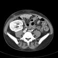 Biliary necrosis - liver transplant (Radiopaedia 21876-21846 B 52).jpg