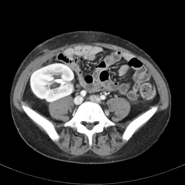 File:Biliary necrosis - liver transplant (Radiopaedia 21876-21846 B 52).jpg