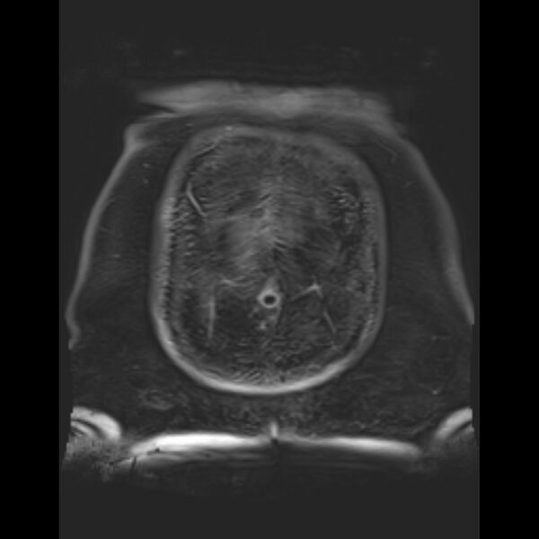 File:Bilobed placenta accreta (Radiopaedia 69648-79591 Coronal T1 vibe 1).jpg
