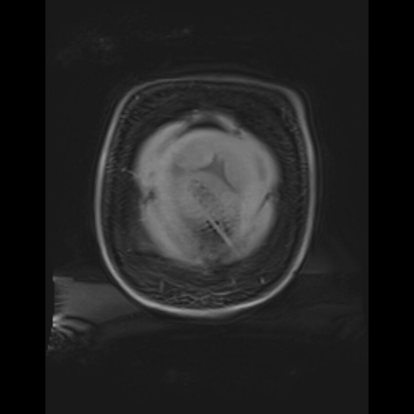 Bilobed placenta accreta (Radiopaedia 69648-79591 Coronal T1 vibe 14).jpg