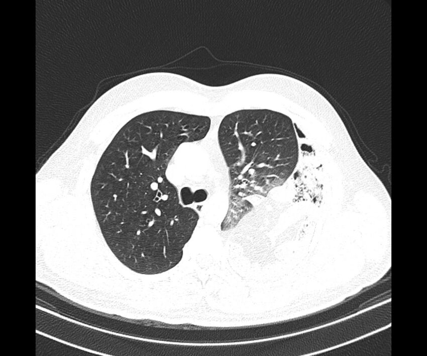 Bochdalek hernia - adult presentation (Radiopaedia 74897-85925 Axial lung window 15).jpg