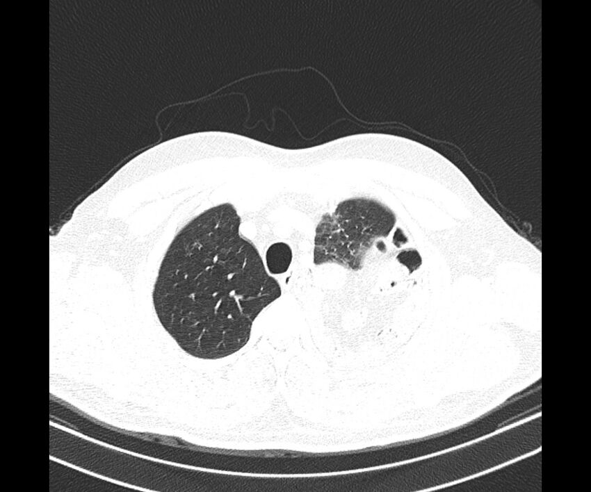 Bochdalek hernia - adult presentation (Radiopaedia 74897-85925 Axial lung window 8).jpg