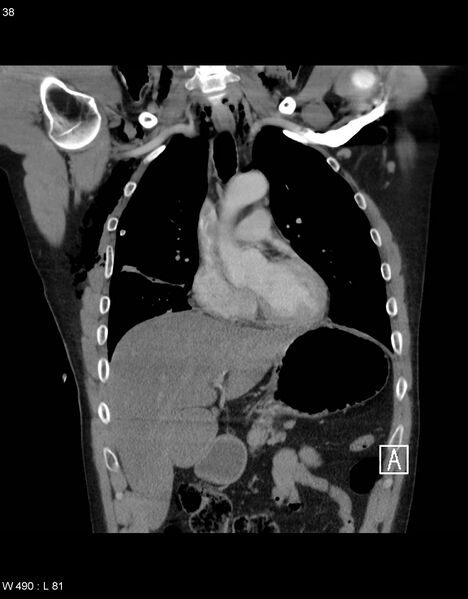 File:Boerhaave syndrome with tension pneumothorax (Radiopaedia 56794-63605 B 14).jpg