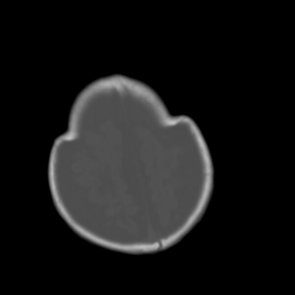 File:Brachycephaly (bi-coronal and bi-lambdoid synostosis) (Radiopaedia 55048-61413 Axial bone window 22).jpg
