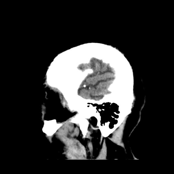 File:Brain Pantopaque remnants (Radiopaedia 78403-91048 C 51).jpg