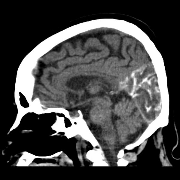 File:Brain cortical laminar necrosis (Radiopaedia 25822-25971 non-contrast 27).jpg
