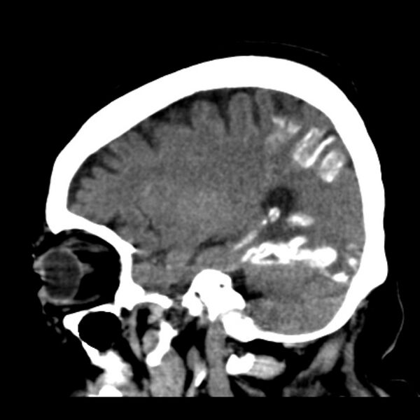 File:Brain cortical laminar necrosis (Radiopaedia 25822-25971 non-contrast 35).jpg