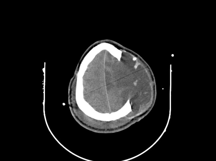 Brain injury by firearm projectile (Radiopaedia 82068-96087 B 155).jpg