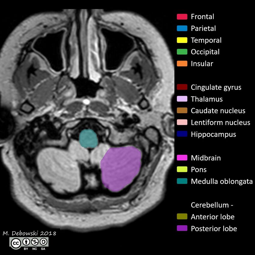 Brain lobes - annotated MRI (Radiopaedia 61691-69700 Axial 72).JPG