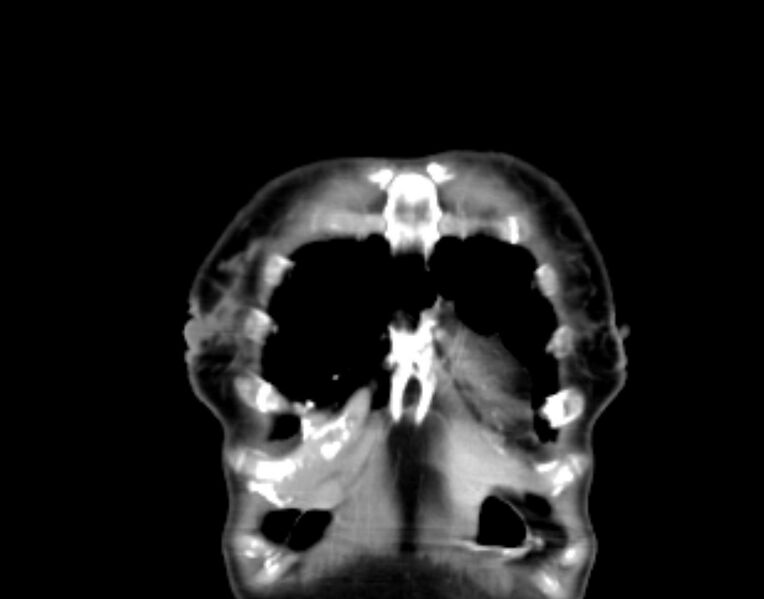 File:Brain metastasis as initial presentation of non-small cell lung cancer (Radiopaedia 65122-74127 C 1).jpg