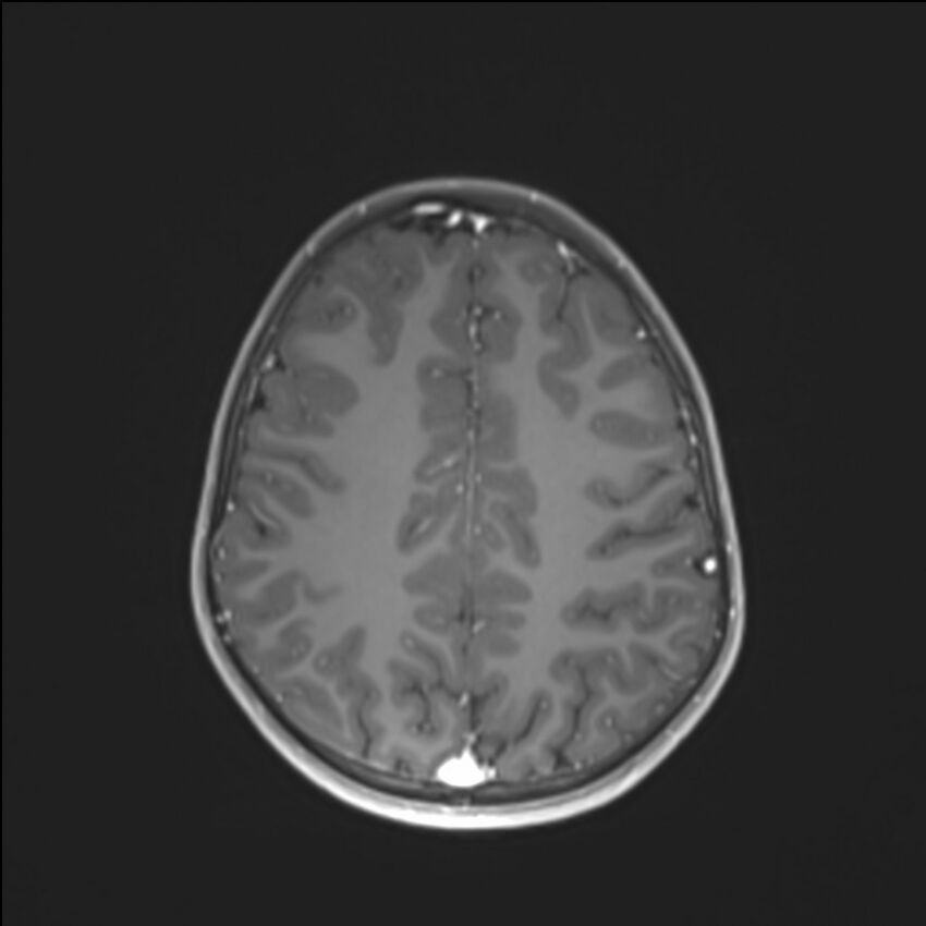 Brainstem glioma (Radiopaedia 70548-80674 Axial T1 C+ 113).jpg