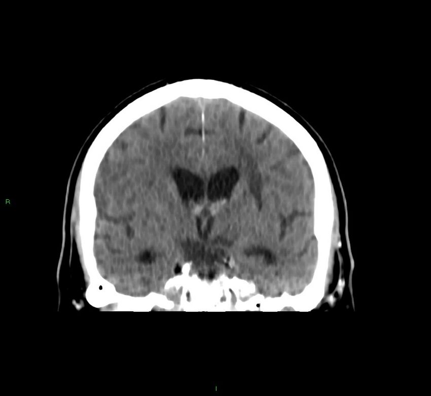 Brainstem hemorrhage (Radiopaedia 58794-66028 Coronal non-contrast 36).jpg
