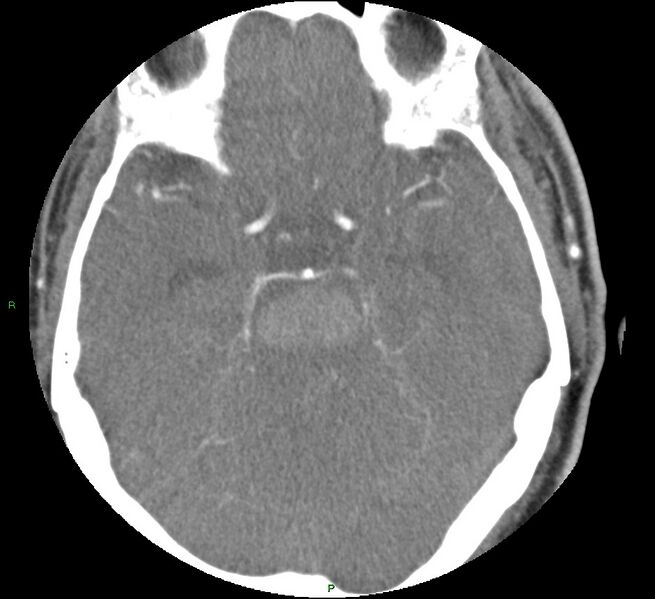 File:Brainstem hemorrhage (Radiopaedia 58794-66028 D 72).jpg