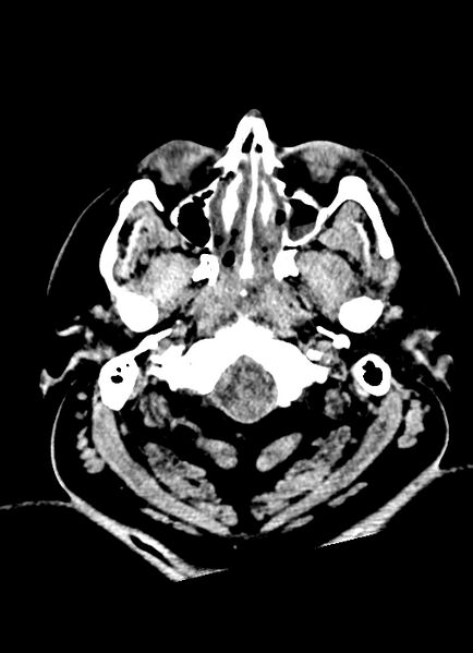 File:Brainstem hemorrhage (Radiopaedia 81294-94976 Axial non-contrast 57).jpg