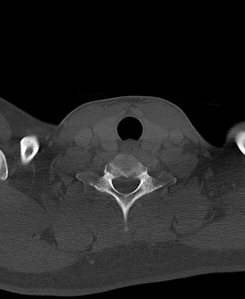 File:Branchial cleft cyst (Radiopaedia 31167-31875 Axial bone window 58).jpg