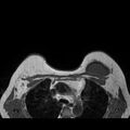 Breast implants - MRI (Radiopaedia 26864-27035 Axial T1 41).jpg
