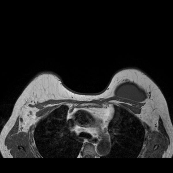File:Breast implants - MRI (Radiopaedia 26864-27035 Axial T1 41).jpg