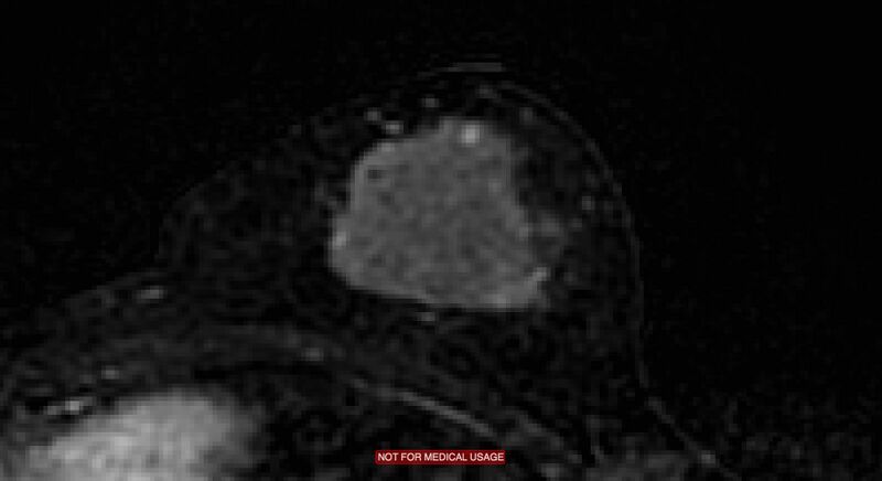 File:Breast lymphoma (MRI) (Radiopaedia 34999-36498 C 11).jpg