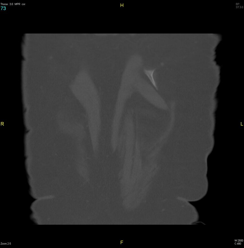 Breast primary with lung and bone metastases (Radiopaedia 40620-43228 bone window 73).jpg