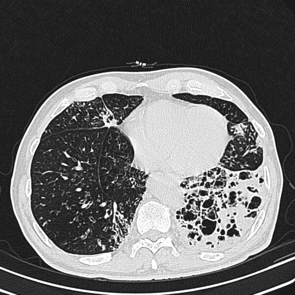 File:Bronchiectasis (Radiopaedia 22061-22059 lung window 22).jpg