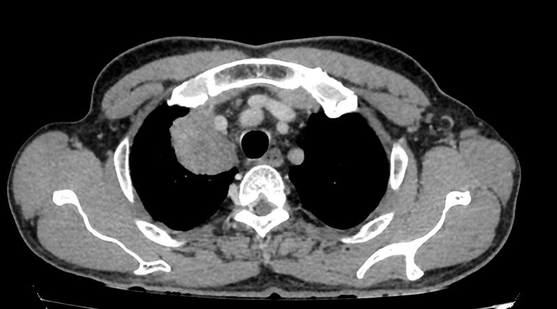File:Bronchogenic carcinoma with superior vena cava syndrome (Radiopaedia 36497-38054 Axial C+ delayed 12).jpg