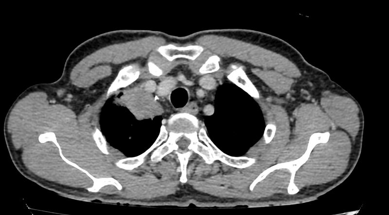 File:Bronchogenic carcinoma with superior vena cava syndrome (Radiopaedia 36497-38054 Axial C+ delayed 8).jpg