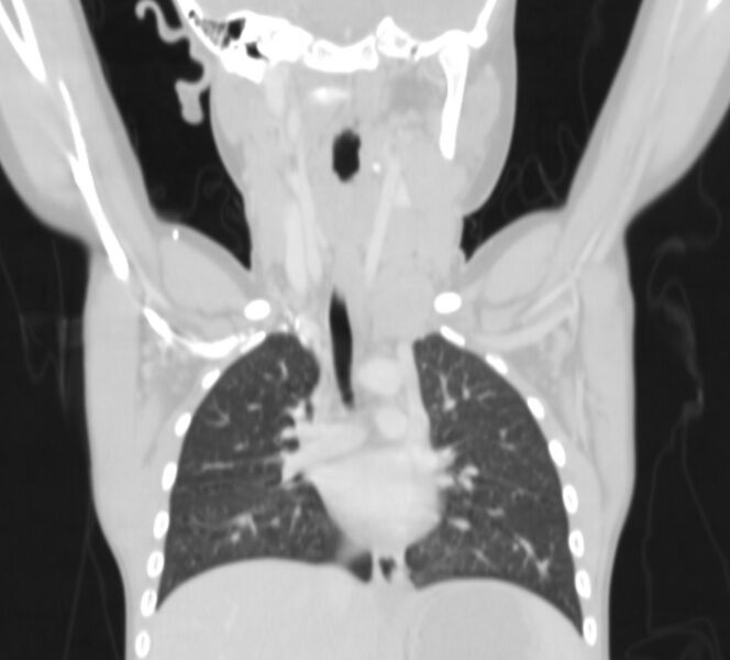 File:Bronchus suis (Radiopaedia 68131-77620 Coronal lung window 3).jpg