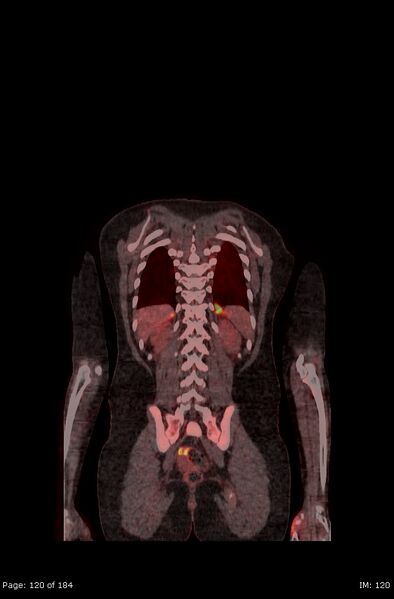File:Brown fat uptake (FDG PET-CT) (Radiopaedia 77392-89513 Fused coronal 78).jpg