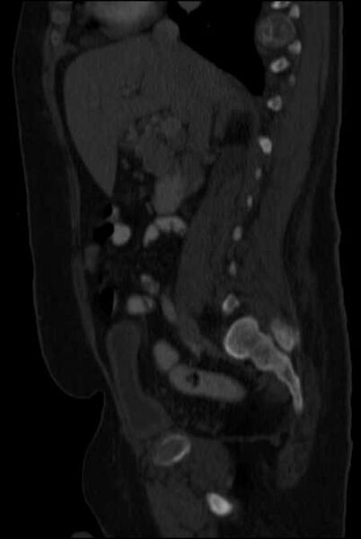 File:Brown tumors compressing the spinal cord (Radiopaedia 68442-77988 H 24).jpg