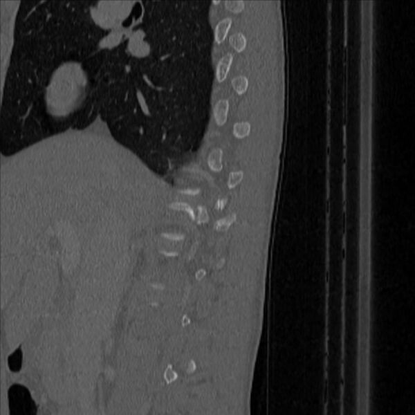 File:Bulging of paraspinal line in traumatic thoracal spinal compression fracture (Radiopaedia 29221-35872 Sagittal bone window 2).jpg