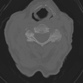 C2 fracture with vertebral artery dissection (Radiopaedia 37378-39199 Axial bone window 28).png