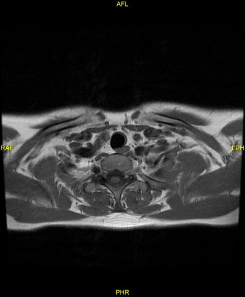 File:C5 nerve sheath tumor (Radiopaedia 85777-101596 Axial T1 25).jpg